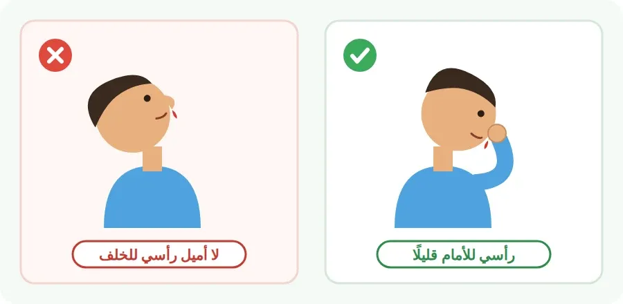 الوضع الصحيح عند نزيف الأنف: الرأس مائل للأمام قليلًا مع ضغط الأنف، والوضع الخاطئ: الرأس مائل للخلف
